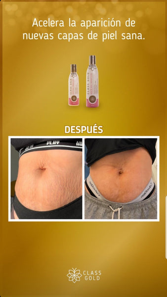 Stretch Marks Multi-benefit Oil 120ML